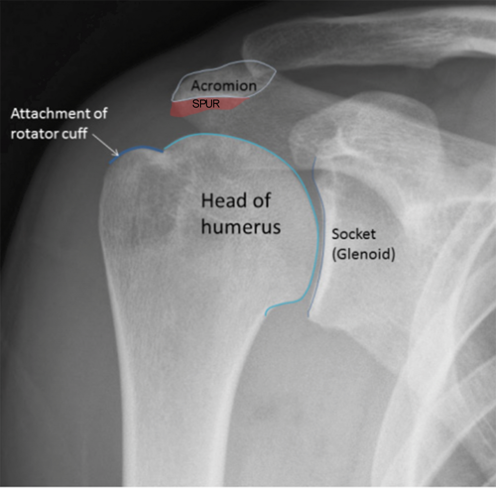 Rotator Cuff Newcastle Shoulder And Elbow Surgeon 